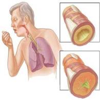 Кашель с мокротой без температуры у взрослого: лечение и причины