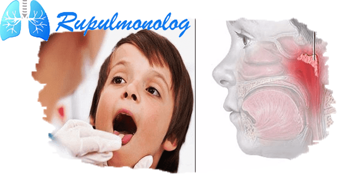 Как лечить кашель при аденоидах