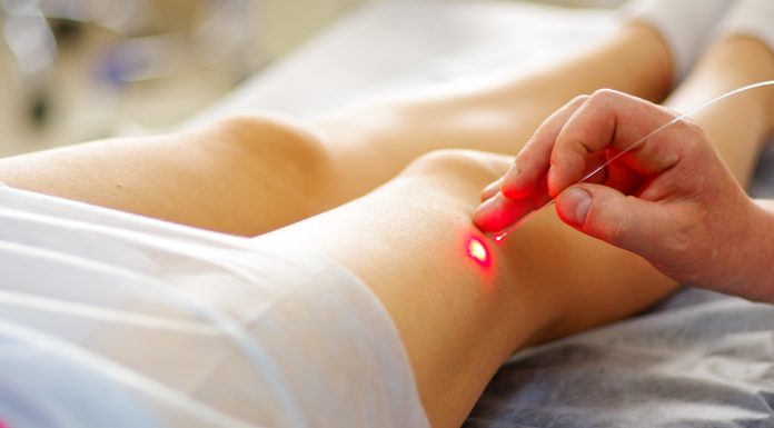 Эндовазальная лазерная коагуляция вен: что это, плюсы, чего ожидать во время и после лечения