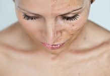 Что делать, если появились пигментные пятна на лице