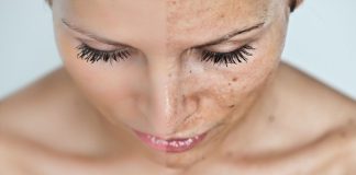 Что делать, если появились пигментные пятна на лице