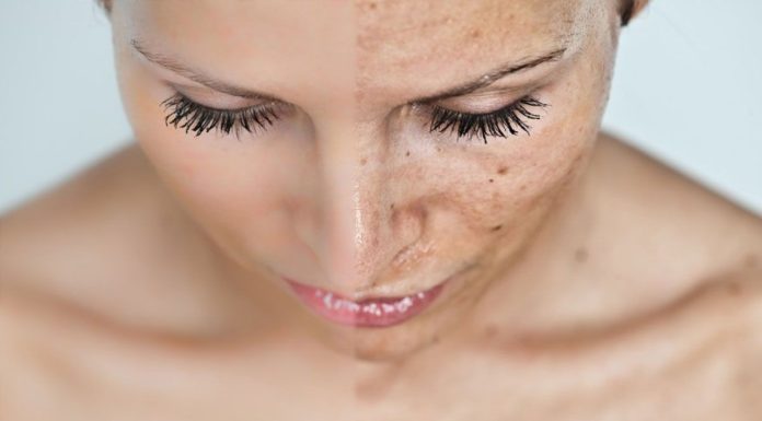 Что делать, если появились пигментные пятна на лице