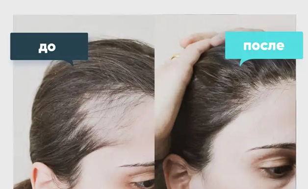 Пилинг: как использовать молочный пилинг правильно