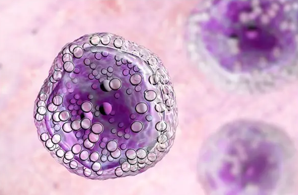 Как вылечить лимфому: советы