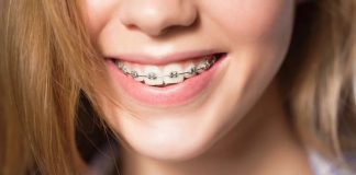 В каких случаях необходимо установить брекеты: советы