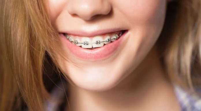 В каких случаях необходимо установить брекеты: советы