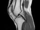 МРТ коленного сустава: полное руководство